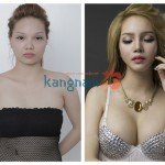 Giải đáp chuyên gia: nâng ngực nâng mũi cùng lúc có được không?