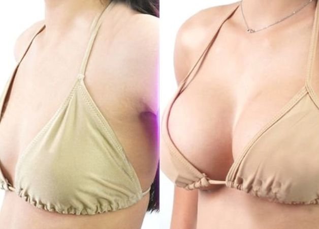 Tạm biệt ngực lép sau khi nâng ngực tại Thẩm mỹ Bệnh viện Hồng Hà