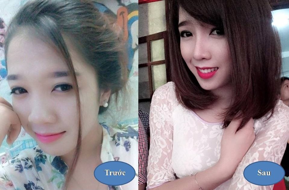 Nâng mũi S line 3D: Xu hướng thẩm mỹ Hot Hàn Quốc 2016 1