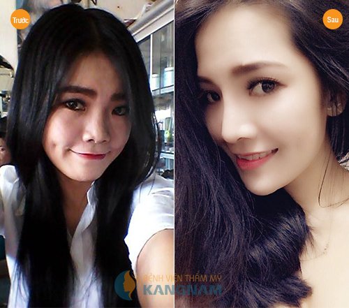 Phẫu thuật nâng mũi như thế nào để đẹp tự nhiên? 2